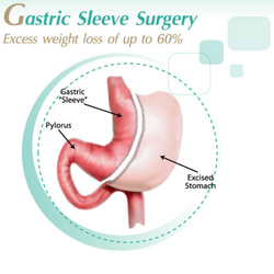 Gastric Sleeve in Mexicali, Mexico by Dr. Garcia Audelo