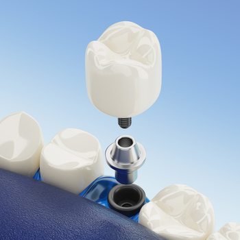 Dental Implants in Cancun, Mexico
