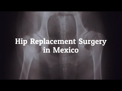Tips to Find the Best Hip Replacement Surgery in Mexico