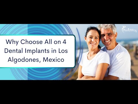 Beautiful Smile with All on 4 Dental Implants Los Algodones