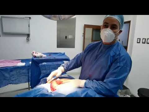 Bariatric Surgery before Cosmetic Surgery in Gastelum Cosmetic Surgery