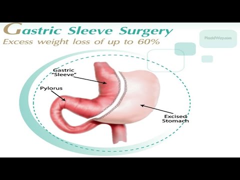 Best Gastric Sleeve Surgery in Mexico