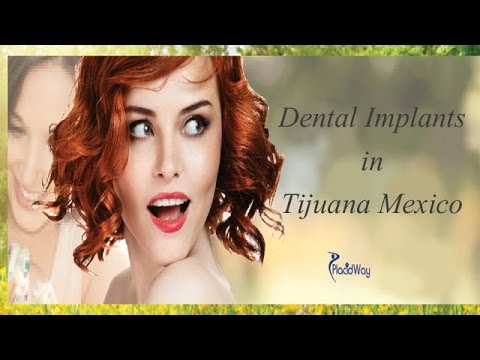Amazing Dental Implants Done in Tijuana Mexico 